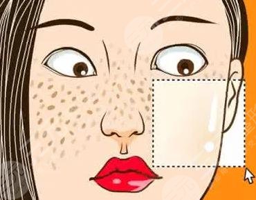 激光去黃褐斑項目