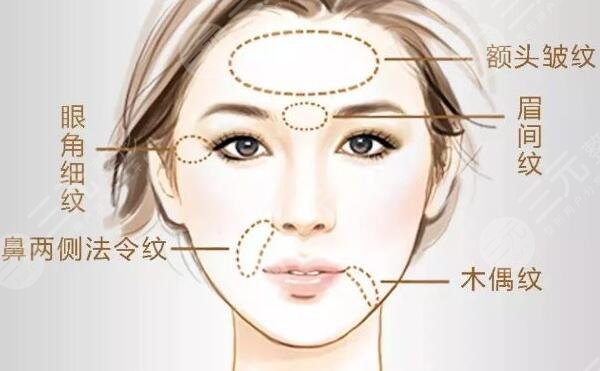 保妥式瘦臉注意事項有哪些