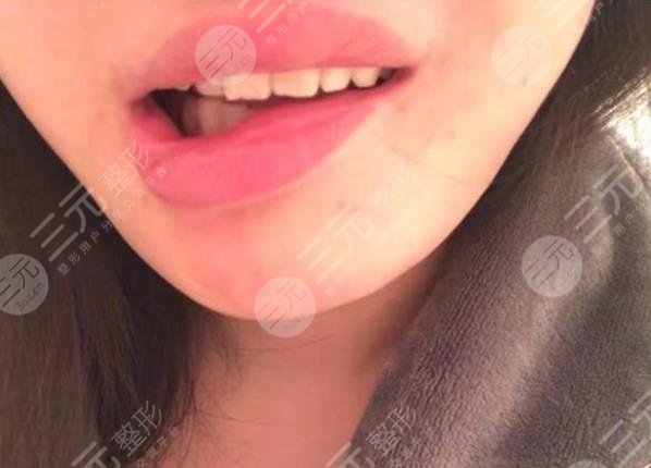 女子整容失敗嘴巴歪，花一年多時(shí)間緩解！整形醫(yī)院只退3.5萬手術(shù)費(fèi)！