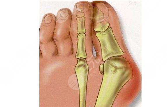 大腳骨項(xiàng)目科普美容