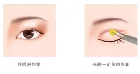 割雙眼皮大概要多少錢?