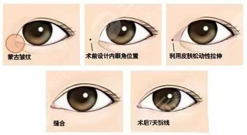 開(kāi)眼角手術(shù)