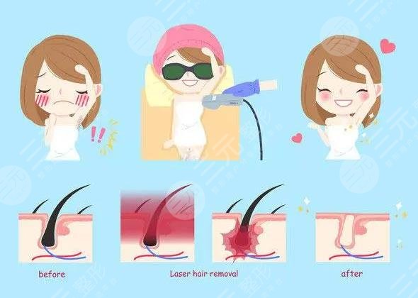 激光脫毛的優(yōu)勢有哪些?