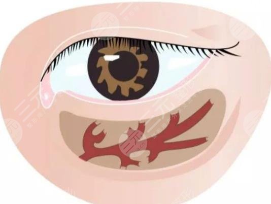 臥蠶的手術方式有哪些 果怎么樣