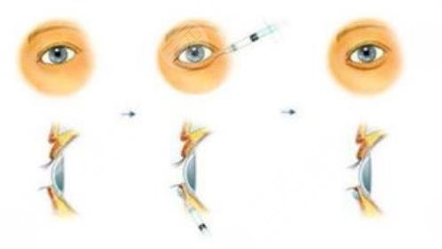 臥蠶的手術方式有哪些 果怎么樣