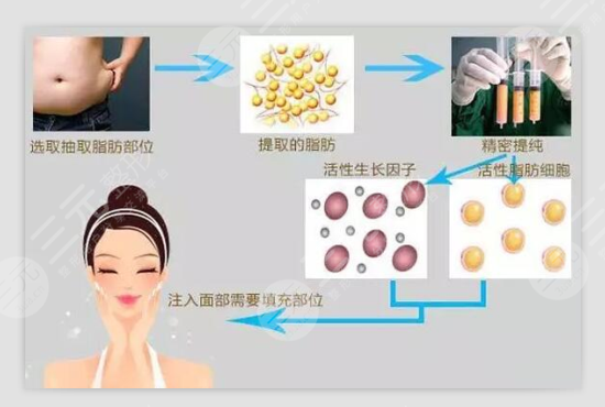 自體脂肪豐面部有神作用?自體脂肪豐面部的作用?