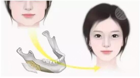 #術(shù)前功課#磨骨瘦臉手術(shù)多少錢？