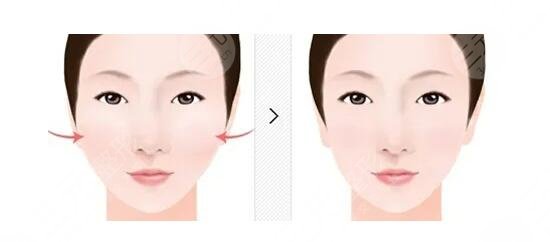 顴弓降低會(huì)下垂嗎