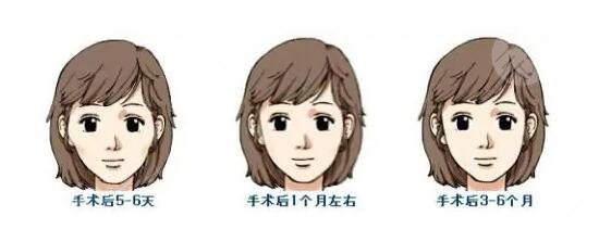 顴弓降低如何操作