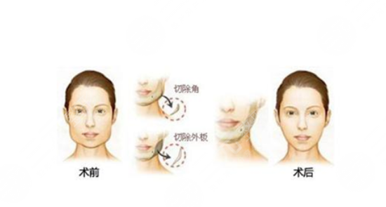 顴骨手術(shù)后面部下垂如何處理