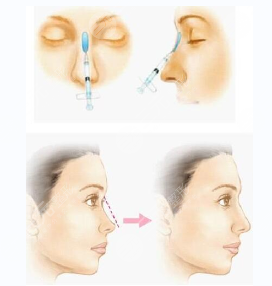 成都注射玻尿酸隆鼻的價(jià)格是多少