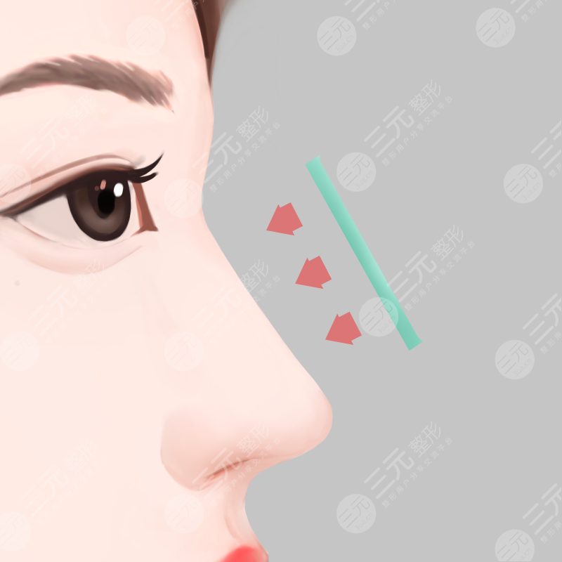 玻尿酸隆鼻的可靠性