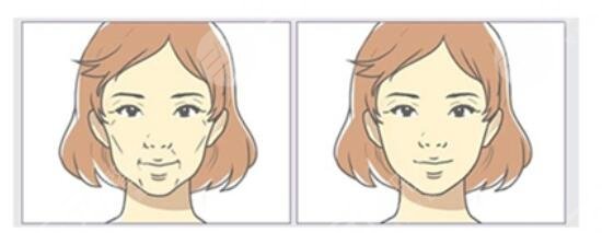 注射法袪魚(yú)尾紋的優(yōu)勢(shì)有哪些