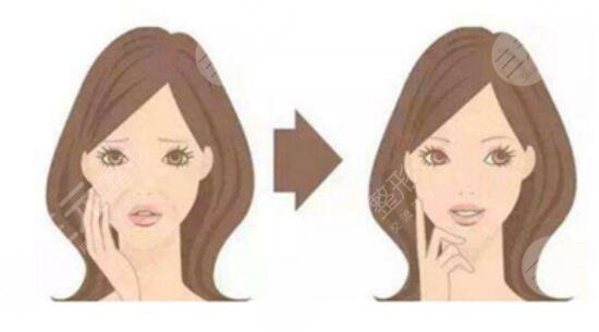 玻尿酸注射去魚(yú)尾紋多少錢(qián) 注射去魚(yú)尾紋成好嗎