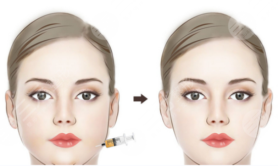 注射瘦臉注射美容多久恢復(fù)自然 注射瘦臉注射美容好嗎