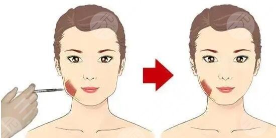 注射瘦臉注射美容多久見(jiàn) 注射瘦臉注射美容有什么注意事項(xiàng)