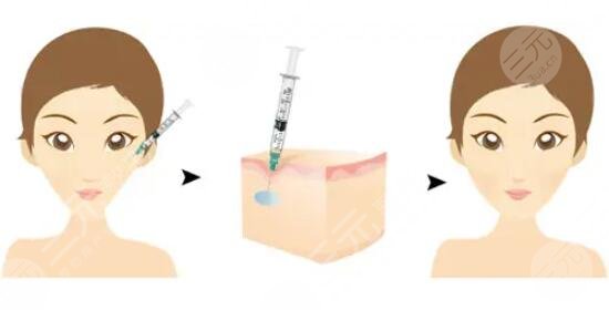 什么是鼻唇溝皺紋 玻尿酸鼻唇溝除皺有用嗎