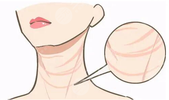 嗨體去頸紋多久能看到果，多少錢一支？?jī)r(jià)格&注意事項(xiàng)幫你盤點(diǎn)好了！