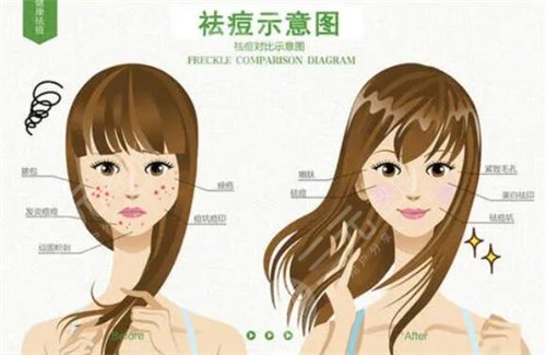 彩光祛痘的價(jià)格