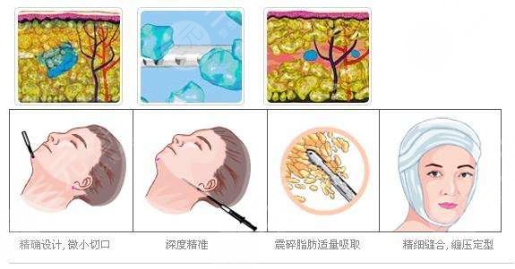 下頜緣緊致提升