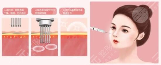 打完水光補(bǔ)水多久可以洗臉