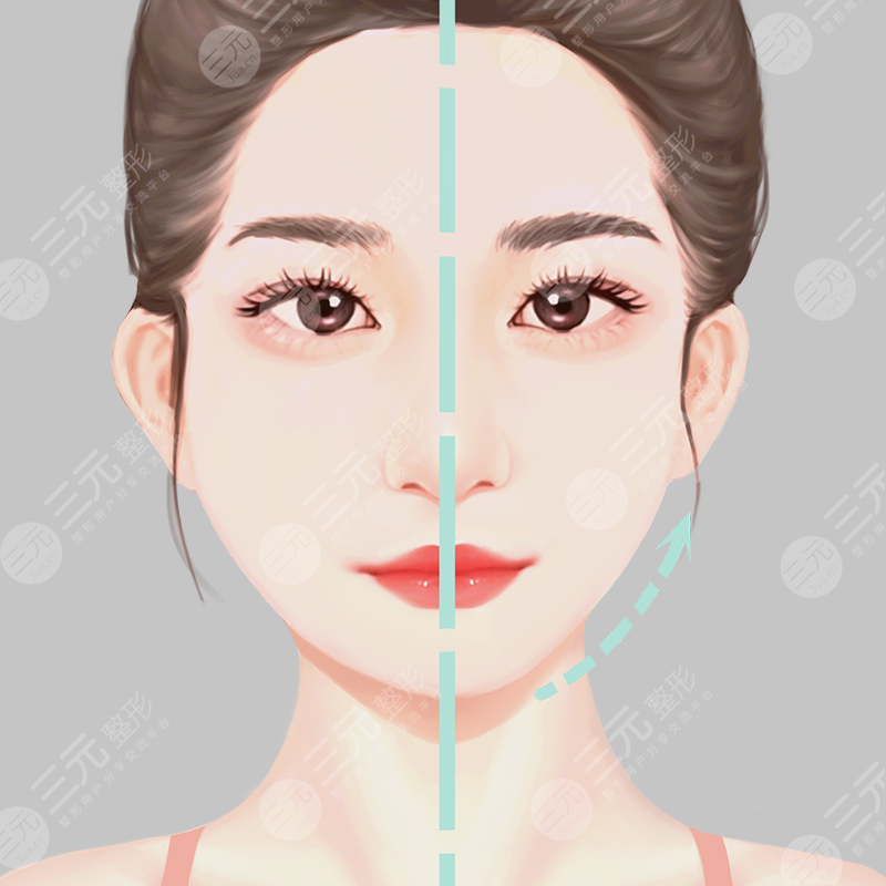 自體脂肪填充蘋果肌會(huì)下垂嗎？優(yōu)勢有哪些？