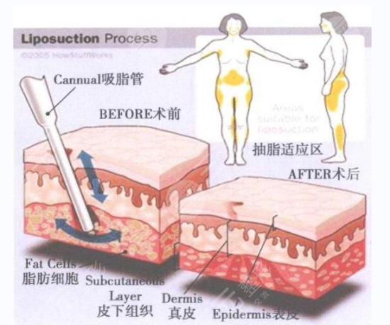自體脂肪的用處這么多，可不止填充臉頰哦~