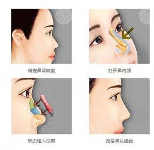 鼻翼缺損修復(fù)手術(shù)的難易程度，手術(shù)大致操作步驟