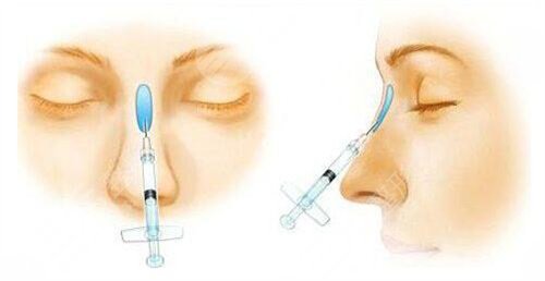 鼻翼缺損修復(fù)手術(shù)難易程度