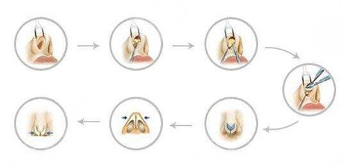 鼻翼缺損矯正手術(shù)會(huì)留疤嗎？