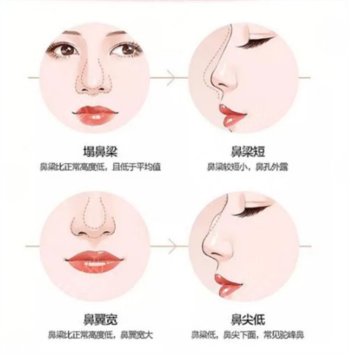 歪鼻手術(shù)的禁忌癥