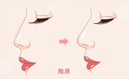 人工骨隆鼻吸收率是多少？手術(shù)前后需要注意的事項(xiàng)