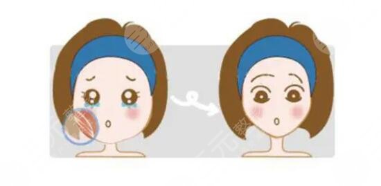 打注射瘦臉變面癱?專家為您解答您被忽悠的事兒 打注射瘦臉變面癱?專家為您解答您被忽悠的事兒