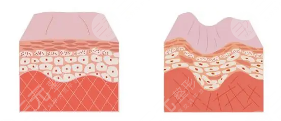 微整形注射美容手術后出現(xiàn)副作用該怎么辦