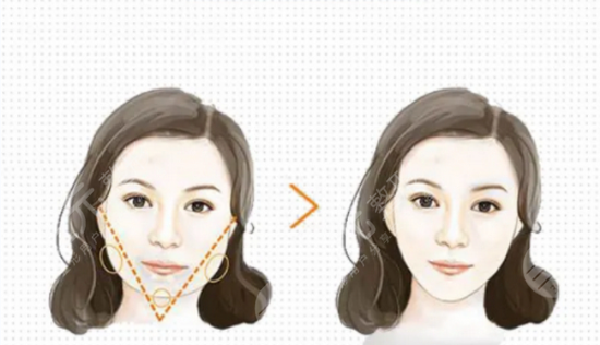 注射瘦臉多久可以代謝掉 注射注射瘦臉有哪些功