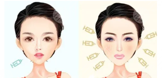 玻尿酸注射豐面頰價(jià)格