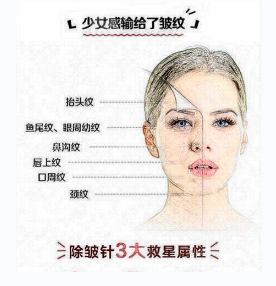 面部注射除皺有幾種類型