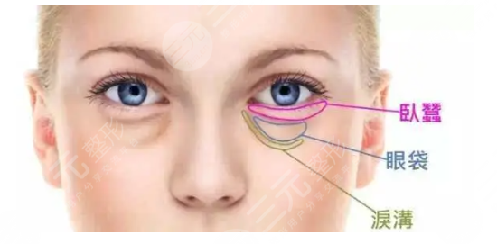 有淚溝怎么辦？怎樣快速祛除淚溝鼻溝紋？