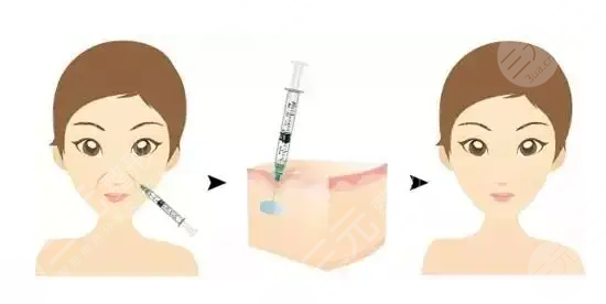 膠原蛋白針作用與功