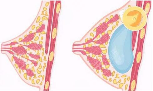 失敗隆胸修復(fù)的難易程度，選擇醫(yī)生小竅門必看！