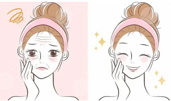 玻尿酸去除法令紋好嗎