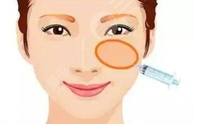 眼部注射玻尿酸好不好?會(huì)比大咖眼霜成好嗎?
