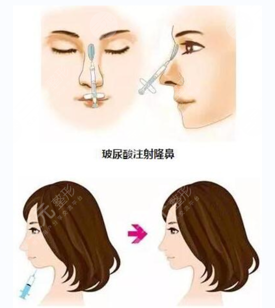 玻尿酸隆鼻到底能保持多久