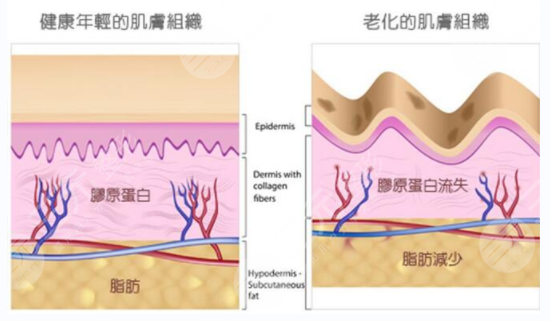一針見，****注射除皺術降低風險嗎?