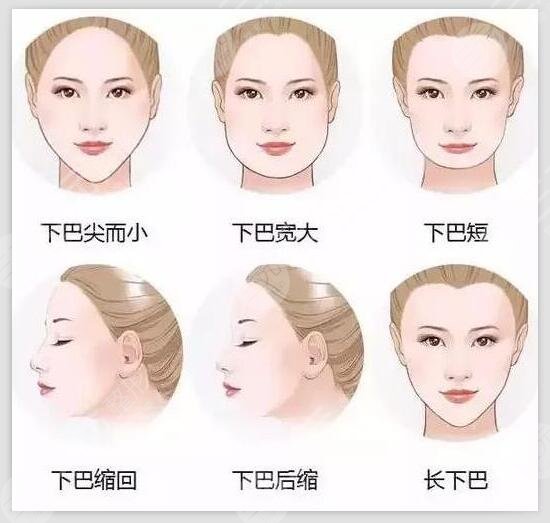 玻尿酸豐下巴價格多少?注射前注意事項