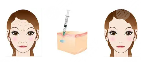 不開刀!透明質酸注射除皺，真的很降低風險嗎?