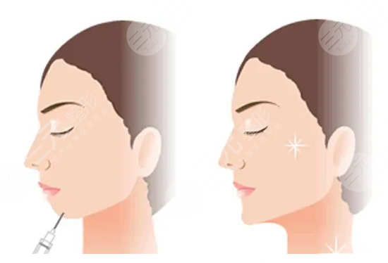 注射玻尿酸降低風(fēng)險(xiǎn)嗎