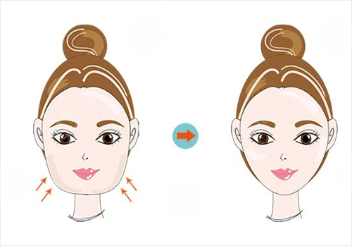 去頰脂墊價格要多少錢 去頰脂墊前后對比圖