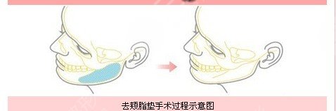 去頰脂墊有副作用嗎 去頰脂墊有后遺癥嗎