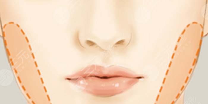 去頰脂墊有副作用嗎 去頰脂墊有后遺癥嗎